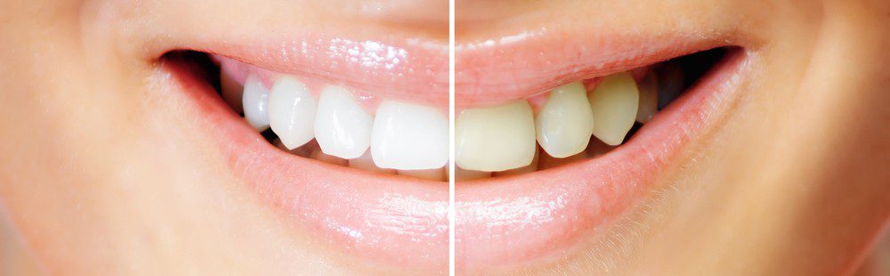 Branqueamento dentário: Clínica Dentária Jardim dos Arcos, em Paço de Arcos