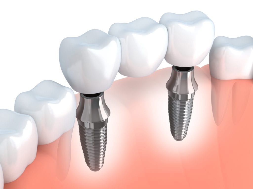 clinica dentaria jardim dos arcos implantes